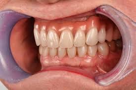 Full Mouth Rehabilitation